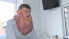 Massive tumor removed from man's face