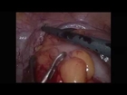laparoscopic low anterior resection for rectal cancer Dr Hamoud Mohamad ,Dr Nordkin Demetri