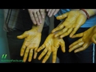 Topical Application of Turmeric Curcumin for Cancer