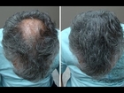 regrow hair naturally for men in hindi - hair regrowth on bald in 6 days