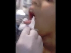 Tongue piercing gone wrong