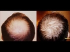 Reverse Hairloss-Best Remedies to Prevent Hair Thinning and Regrow Healthier &Thicker Hair