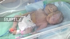 State of Palestine: Conjoined twins with two heads and one body born in Gaza
