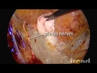 TME for rectal cancer laparoscopic dissection of the Holy Plane using 3 directional 3D retraction