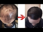 how to regrow hair at home - how to regrow hairline for men - regrow hair treatment
