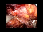 Transanal TME for low rectal cancer