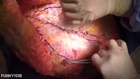 Triangular Repair of Pan Abdominal Wall Laxity - Abdominoplasty with Barbed Suture